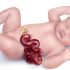 gastrosquisis-bebe-cirujano pediatra en cancun